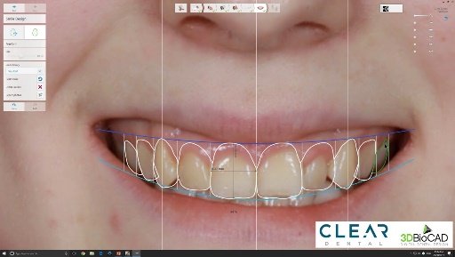 Smile Design Principles in Full Mouth Rehabilitation: Aesthetic and Cosmetic Prosthodontics 13 t3 4