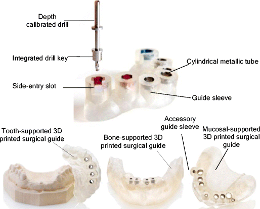 Digital Implant Planning with Surgical Guides: A Comprehensive Guide for Modern Dentistry 22 t4