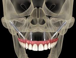 Panoramic radiograph showing a zygomatic implant anchored in the zygomatic bone for maxillary rehabilitation