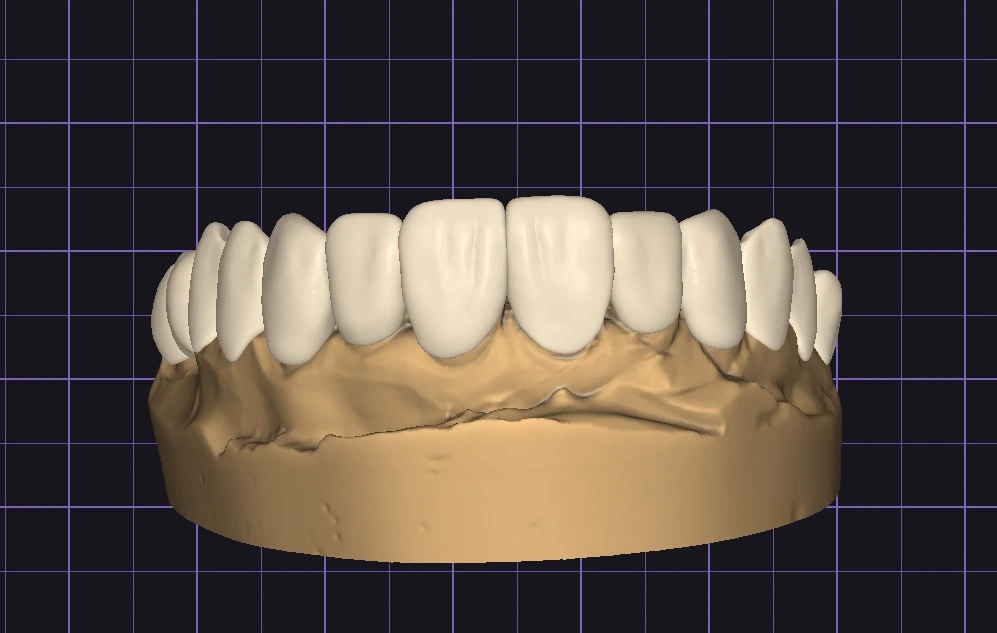 Digital diagnostic wax-up designed in CAD software showing ideal tooth anatomy and occlusion. This virtual model serves as the master design for the 3D printed resin stamp guides.