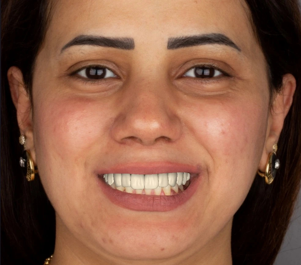 Realistic digital smile simulation overlaying the white diagnostic wax-up onto the patient's facial photo. Used by Dr. Haitham Sharshar to verify the smile curve and tooth proportions before 3D printing.