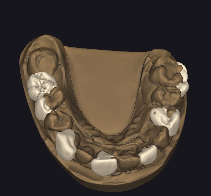 Occlusal view of the intercalated digital wax-up in exocad, showing every other tooth restored while adjacent teeth remain as natural stumps. This "skip-tooth" model design is used to prevent interproximal fusion during the resin stamp technique.