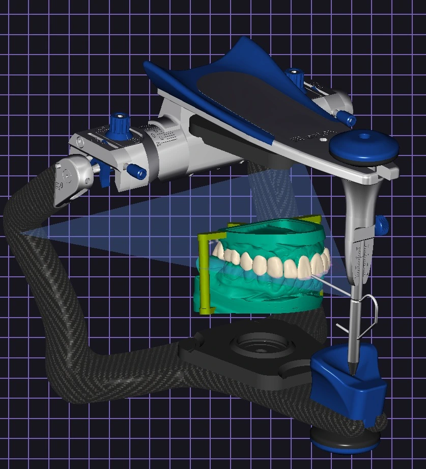 Digital diagnostic wax-up mounted on a virtual articulator in exocad to verify dynamic occlusion and functional movements before 3D printing the resin stamp guides.