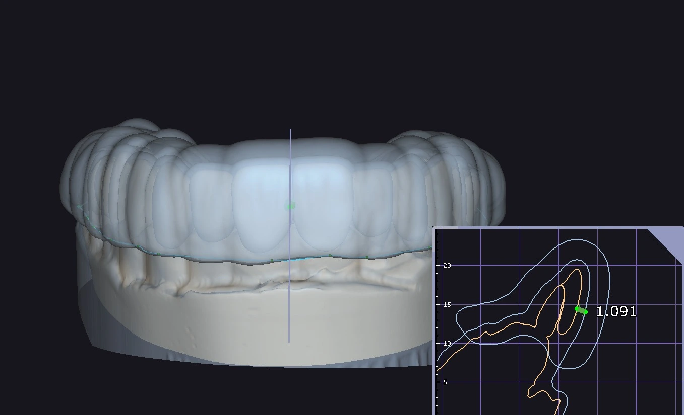 Digital design of a resin stamp guide in exocad BiteSplint module showing a 1 mm internal offset parameter. This space is created to accommodate the silicone liner for the composite injection technique.