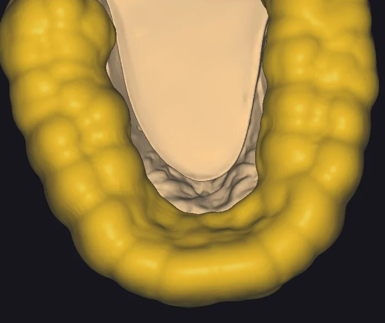 Final CAD design of the resin stamp guide in exocad, shown as a yellow mesh ready for export. This 3D printable index is used to transfer the composite restoration to the patient's mouth.