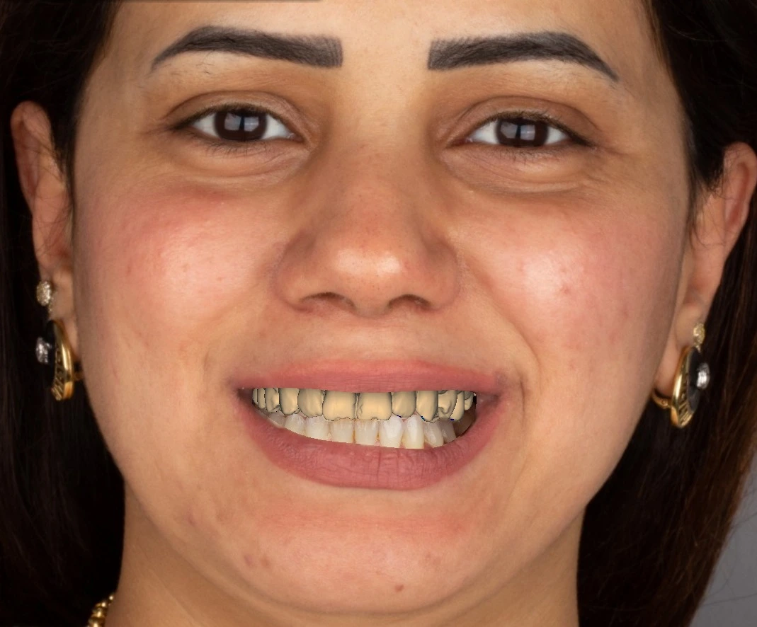 Digital 3D diagnostic wax-up overlaid on patient facial photo to verify midline and incisal edge position before 3D printing the resin stamp guide.