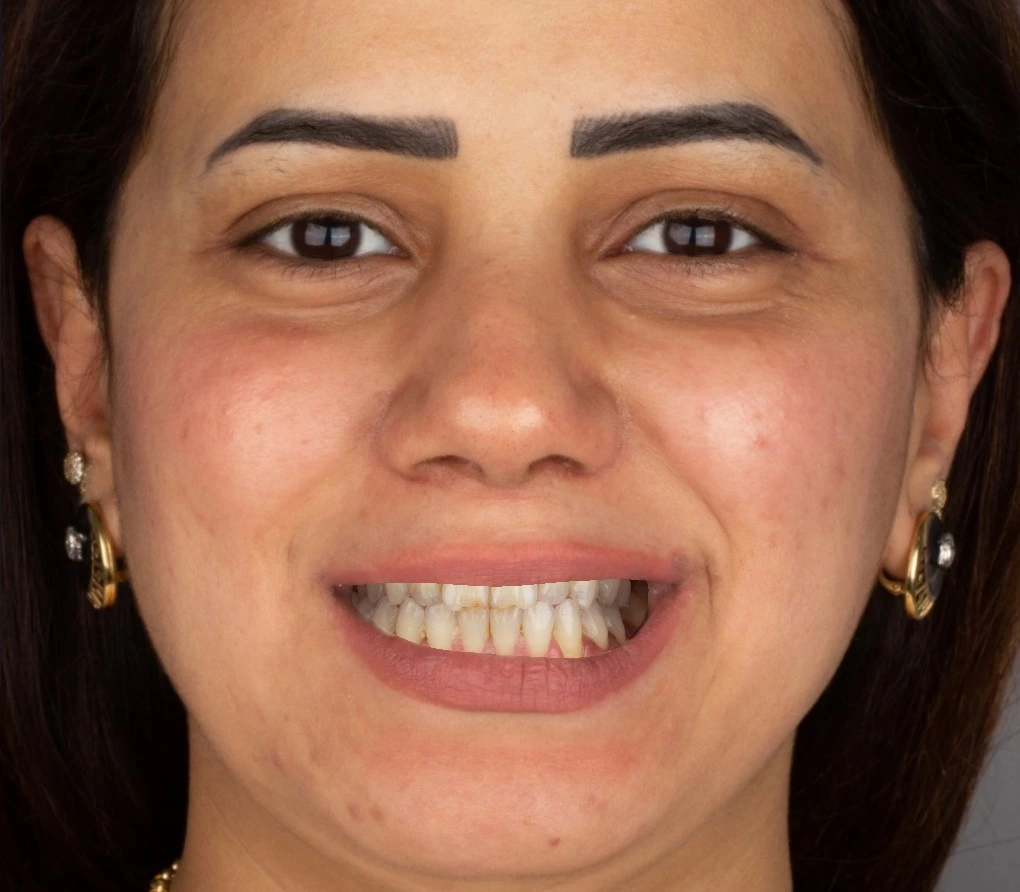 Pre-operative full facial portrait of a patient for facially driven smile design planning. Used by Dr. Haitham Sharshar to align the digital wax-up for the Resin Stamp Technique.