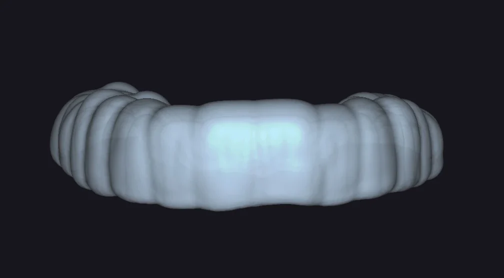 Final digital design of the resin stamp guide created in exocad BiteSplint module by Dr. Haitham Sharshar. This 3D printable shell features a 1mm internal offset for silicone relining, following the complete digital workflow described in the JPD.