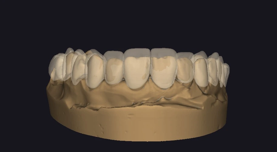 Transparent digital wax-up overlay in exocad showing the volume difference between the original teeth and the proposed design. This visualization is used to plan the composite thickness for the resin stamp technique.