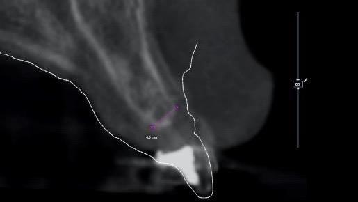 Bone Grafting Materials: Comparing Evidence for Oral Reconstruction 3 Cross-sectional CBCT with a planned prosthetic outline and the source measurement label at the narrow ridge.