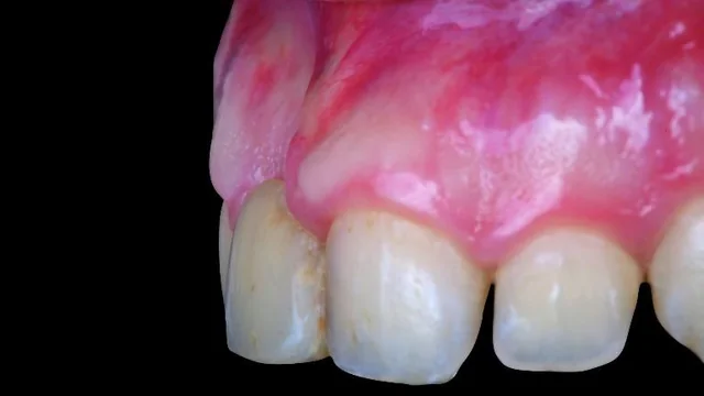 Bone Grafting Materials: Comparing Evidence for Oral Reconstruction 2 Oblique intraoral view of the deficient ridge at the right central-incisor site with the temporary restoration in place.