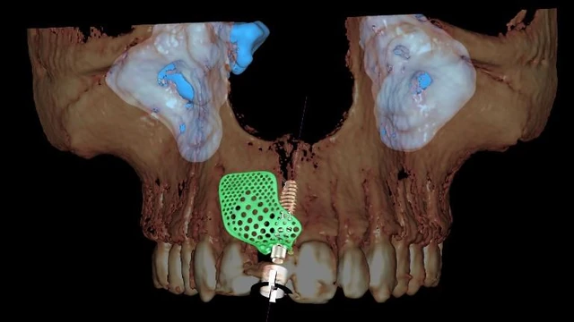 Bone Grafting Materials: Comparing Evidence for Oral Reconstruction 4 Three-dimensional maxillary rendering with a green mesh design and a planned implant at the central-incisor site.