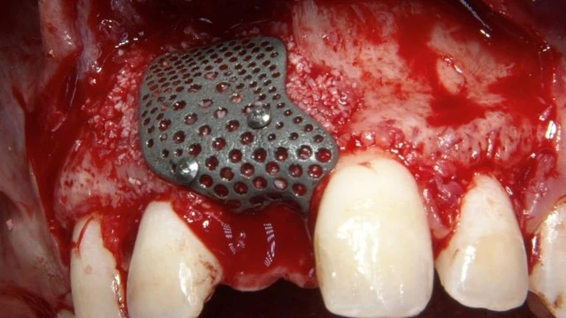 Bone Grafting Materials: Comparing Evidence for Oral Reconstruction 5 Intraoperative anterior-maxillary view showing the custom titanium mesh fixed over the augmented buccal site.