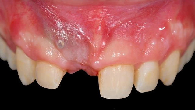 Bone Grafting Materials: Comparing Evidence for Oral Reconstruction 6 Intraoral frontal view of the anterior site before second-stage surgery at four months.