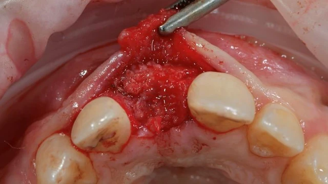 Bone Grafting Materials: Comparing Evidence for Oral Reconstruction 7 Occlusal surgical view of the anterior augmented site during second-stage treatment.