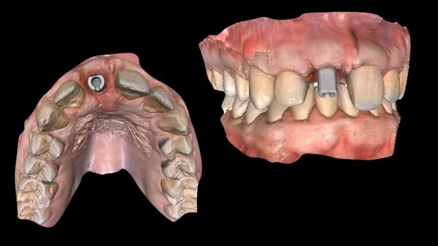 Bone Grafting Materials: Comparing Evidence for Oral Reconstruction 8 Two intraoral-scan views: an occlusal maxillary view and a frontal view with a scan body.