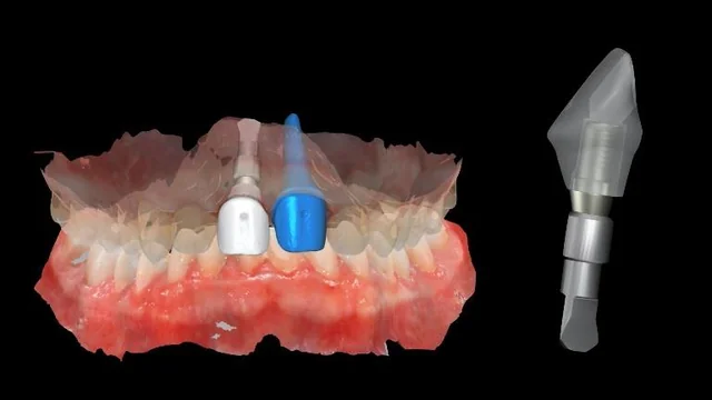 Bone Grafting Materials: Comparing Evidence for Oral Reconstruction 9 CAD composite showing proposed anterior restorations on the scan and a separate digital component view.