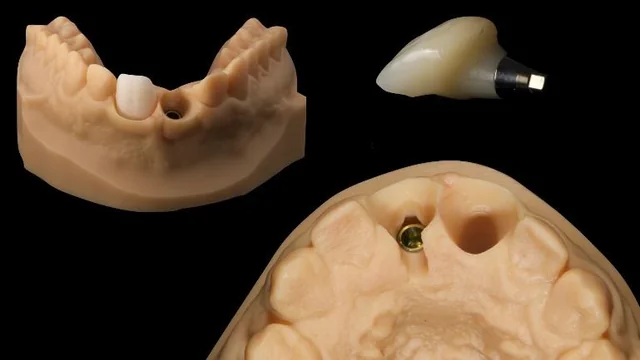 Bone Grafting Materials: Comparing Evidence for Oral Reconstruction 10 Three product/model views: a printed cast, the hybrid crown on a titanium base, and an occlusal model view.