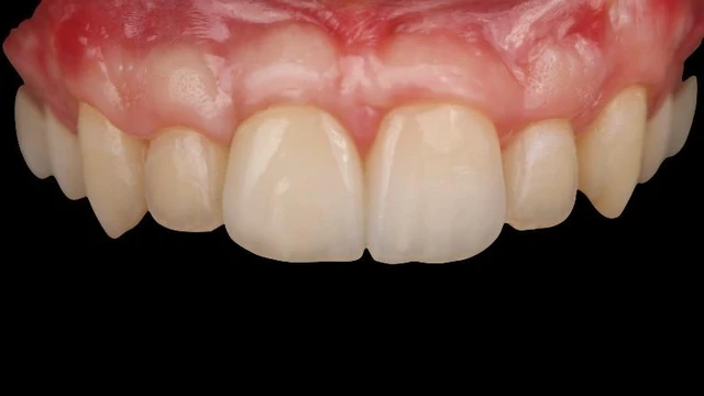 Bone Grafting Materials: Comparing Evidence for Oral Reconstruction 11 Frontal intraoral view of the restored maxillary central incisors.