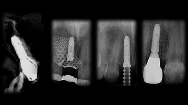 Bone Grafting Materials: Comparing Evidence for Oral Reconstruction 12 One cross-sectional CBCT image and three periapical radiographs showing the mesh/implant and later restored implant.