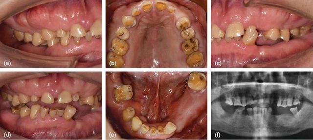 Five pretreatment intraoral views of worn and missing teeth, with a panoramic radiograph from the same published adult case.