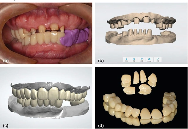 Four panels show sectional provisional removal with an interarch record, digital master models, full-contour CAD and fabricated zirconia restorations.