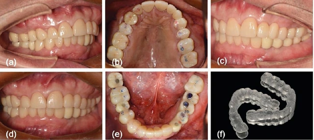 Five delivery-stage intraoral views of the definitive restorations and a sixth panel showing the protective nocturnal splint.