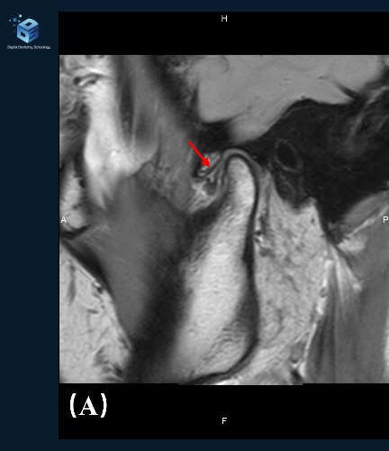 The source left-TMJ MRI in intercuspal position, including the original red disc arrow and imaging markers, with a small DDS logo in a separate margin.