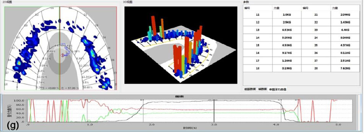 Delivery-stage occlusal-analysis maps and a time plot from the same case, not an EMG trace.