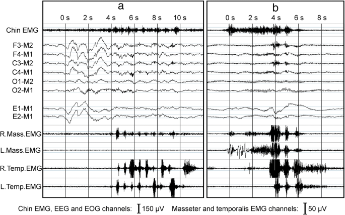 Two sleep-recording excerpts with jaw-muscle EMG, EEG and eye-movement channels, illustrating missed or overcounted masticatory events when contextual information is unavailable.
