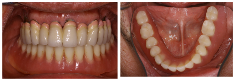 Frontal and occlusal clinical photographs of the existing mandibular overdenture.