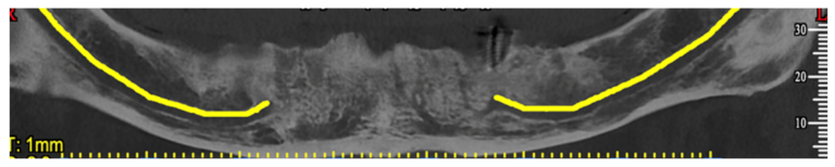 Panoramic CBCT reconstruction showing the edentulous mandible, existing implant and marked mandibular nerve paths.