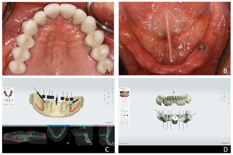Four panels show clinical arches, virtual implants and fixation pins, and an exploded digital two-part surgical-guide design.