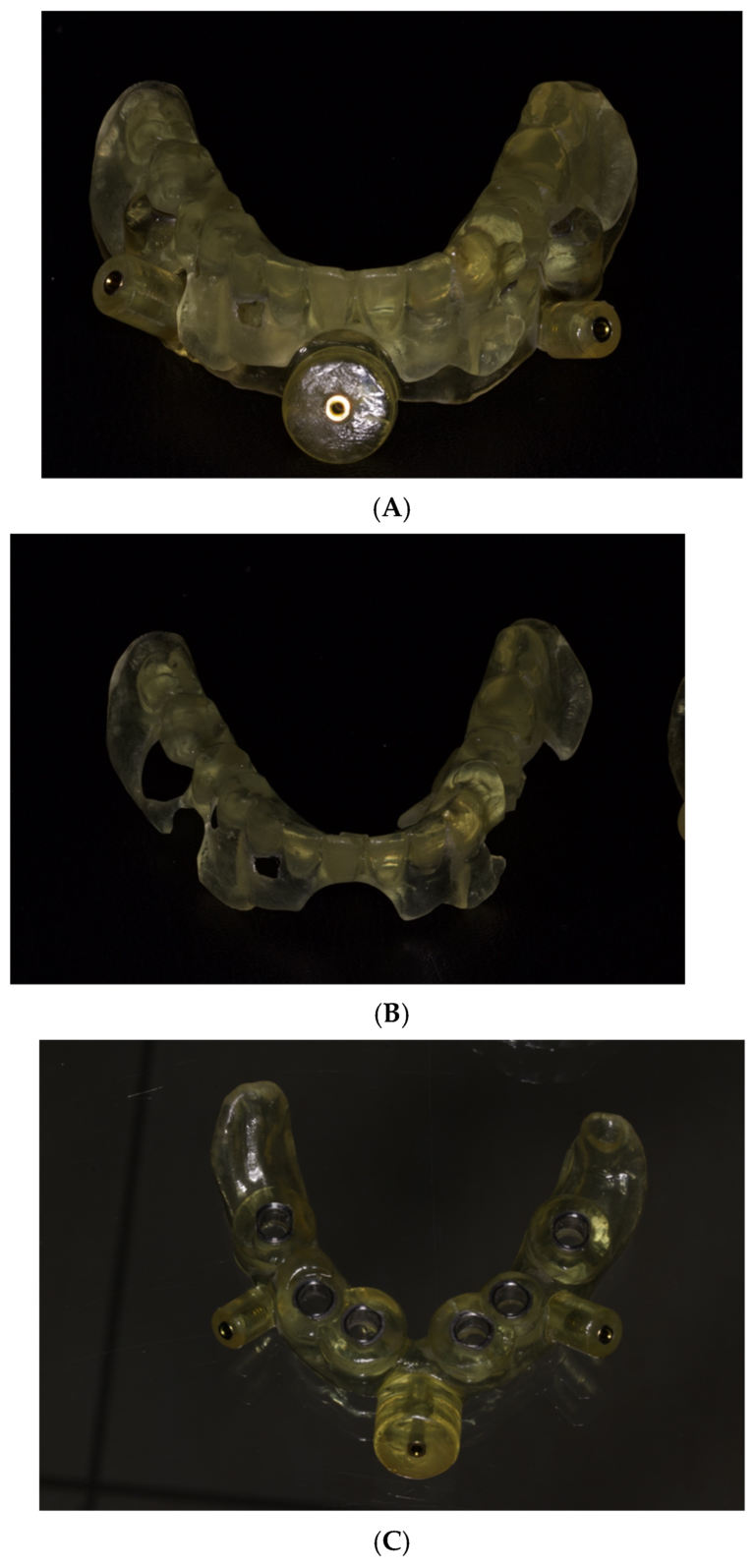 Three photographs show the assembled two-piece guide, occlusal positioning component and surgical component with sleeves.