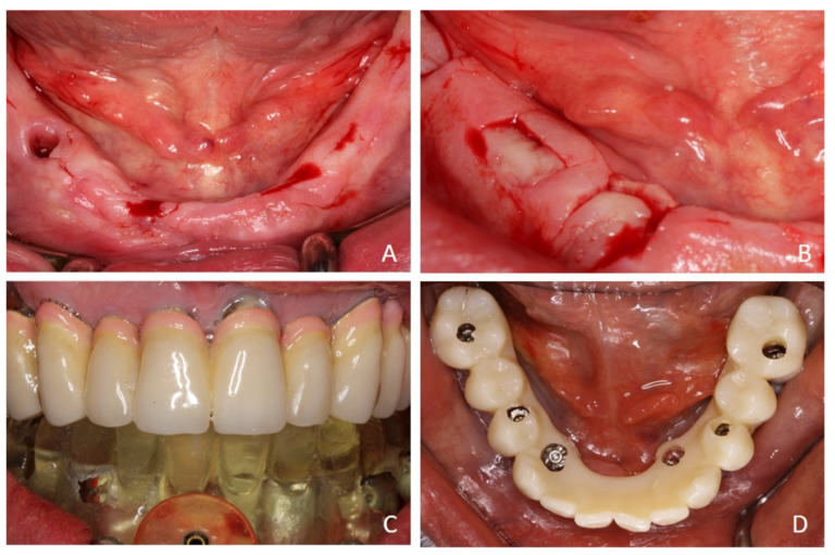 Four clinical panels show marked mandibular sites, incisions, the seated guide and the provisional restoration positioned after implant placement.
