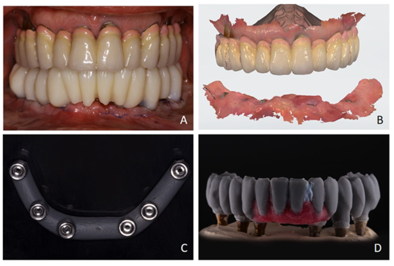 Clinical provisional restoration, digital articulation, printed verification jig and printed prosthetic trial.
