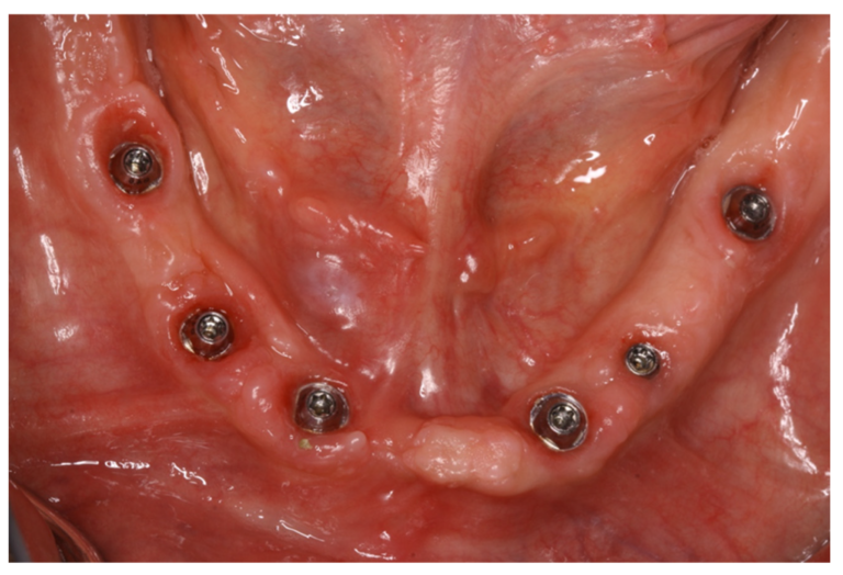 Occlusal clinical photograph of mandibular soft tissues surrounding six multi-unit abutments.