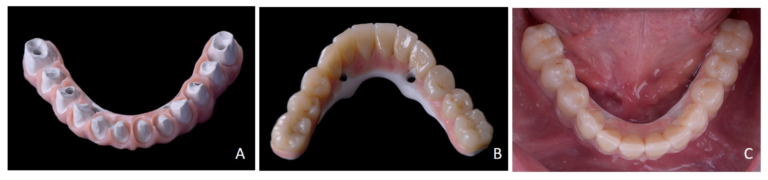 Three panels show the PEEK framework, completed definitive restoration and its intraoral delivery.