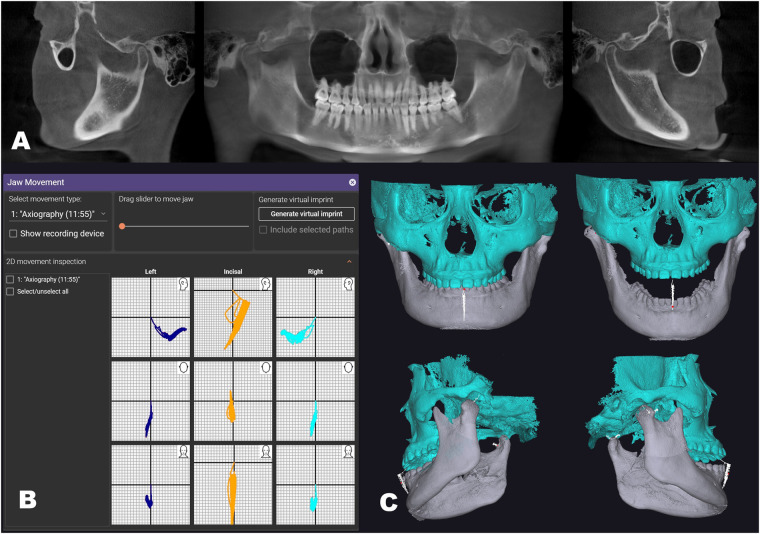 Composite of CBCT jaw views, left/incisal/right motion traces, and fused three-dimensional jaw models following recorded movement.