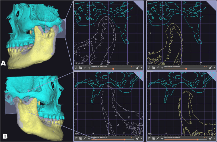 Left and right condyle–fossa planning views comparing gray initial and yellow selected forward mandibular positions.