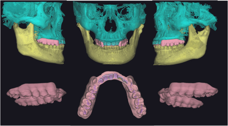 Six CAD views of the pink maxillary splint, including its occlusal surface and its relationship to the virtual jaws.