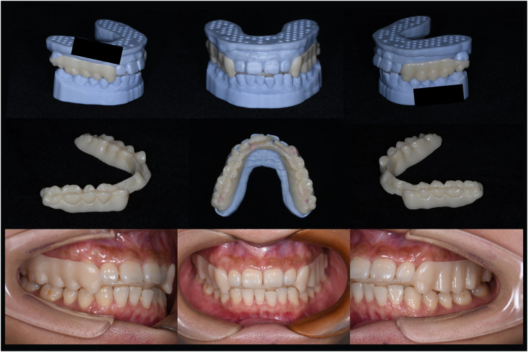 Nine-view composite: the physical maxillary splint alone and on dental casts in the top and middle rows, with three intraoral delivery views along the bottom; source black masks retained.
