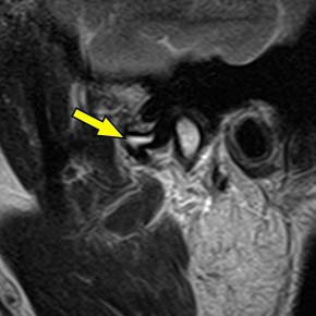 Right TMJ closed-mouth MRI from the published nonreducing-disc case, Figure 2a; the yellow arrow marks joint effusion.