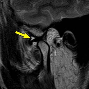 Matching right TMJ open-mouth MRI, Figure 2b; the source identifies persistent disc displacement, and the yellow arrow marks effusion.