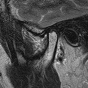 Right TMJ, closed-mouth sagittal-oblique T2 MRI from the published reducing-disc case, Figure 1a.