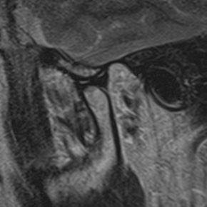Matching right TMJ open-mouth MRI, Figure 1b, which the source identifies as showing disc reduction.