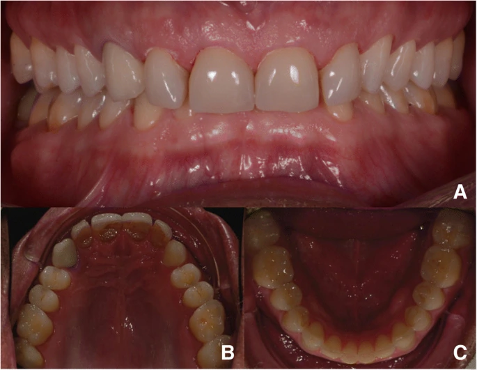 Impact of Parafunctional Habits on Prosthetic Success: Considering Occlusion and Functional Dynamics 3 Three-panel pretreatment intraoral photographs from the published case.
