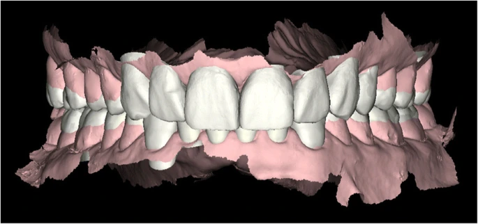 Impact of Parafunctional Habits on Prosthetic Success: Considering Occlusion and Functional Dynamics 4 Digital rendering of the upper and lower dental arches before treatment.