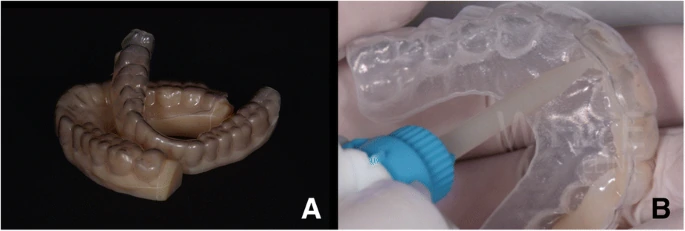 Impact of Parafunctional Habits on Prosthetic Success: Considering Occlusion and Functional Dynamics 5 Digital-design model and transparent matrix containing mock-up material.