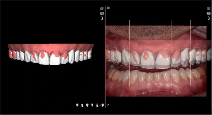 Impact of Parafunctional Habits on Prosthetic Success: Considering Occlusion and Functional Dynamics 7 Dental design displayed alongside an intraoral photograph with planning guides.